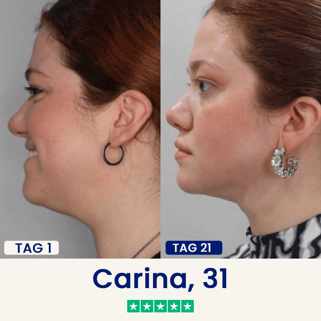 Der Chinology™ Lift